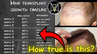 Hair Transplant growth timeline  Month 19  Norwood 5 [upl. by Neirod]