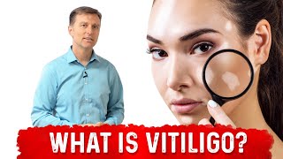 What is Vitiligo Explained By Dr Berg [upl. by Ethelstan406]