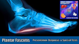 Plantar Fasciitis  Presentation Diagnosis amp Special Tests [upl. by Adlaremse]