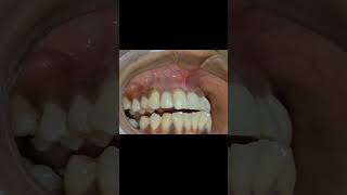 Upper lateral incisor implant crown protrusion inference checking video shorts [upl. by Siocnarf822]