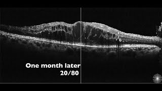 Diabetic Macular Edema Treatment  Retina Center Tijuana [upl. by Deeraf]