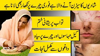 ONE SOLUTION  REMOVE ACNE SCARS PIMPLES AT HOME  GUARANTEED  Dr Bilquis Shaikh [upl. by Atihcnoc]