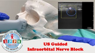 Infraorbital Nerve Block Ultrasound Guided [upl. by Lois841]