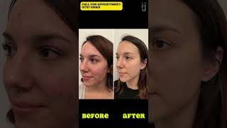 13 steps in 1 day Hydra Facial [upl. by Lanni]