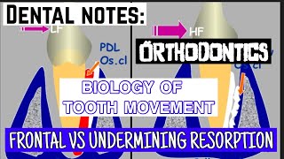 FRONTAL VS UNDERMINING RESORPTION  BIOLOGY OF TOOTH MOVEMENT [upl. by Haisa539]