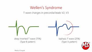 Wellens Syndrome with ECG and Angiography example [upl. by Quartus]