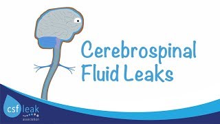 An Introduction to Cerebrospinal Fluid CSF Leaks [upl. by Nilam]