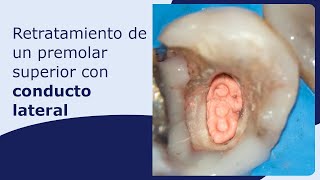 Retratamiento de un premolar superior con conducto lateral [upl. by Amersham553]