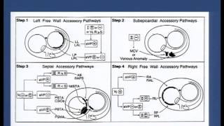 Pre  excitation syndromes  Dr Shashidhar 29092013 18 [upl. by Eniahs]