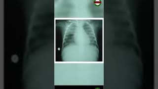 What Is Pulmonary Edema [upl. by Adnileb]