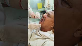 complex root canal of mandibular premolar [upl. by Ayalat]