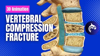 See how Osteoporosis Affects the Spine Vertebral Compression Fractures [upl. by Eulalie957]