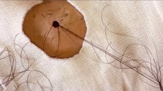 Removal of ingrown hair Eliminación de pelo encarnado [upl. by Milak]