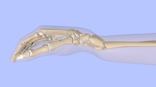 Closed Reduction of a Distal Radius Fracture [upl. by Lowney]