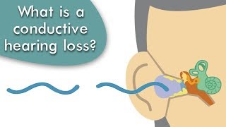 Conductive Hearing Loss Explained [upl. by Livingston74]