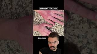 Margarita dermatitis is caused by WHAT morbidfacts [upl. by Laverne350]