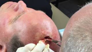 Removal of galeal lipoma on scalp [upl. by Callida]