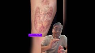 THE EFFECTS OF DIABETES ON SKIN  A MUST WATCH AND SHARE VIDEO IMG 9160 [upl. by Onaicnop324]