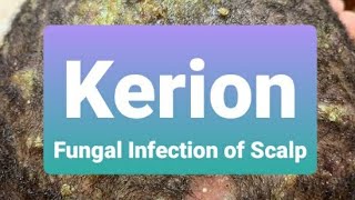 Kerion  Insight and Treatment [upl. by Ycniuqed]