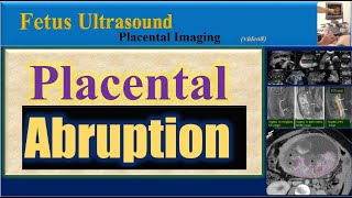 Fetus Ultrasound  Placental Abruption [upl. by Longmire131]