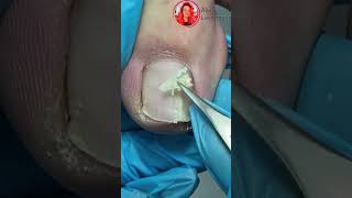 Врос ноготь на ноге Что делать Ingrown nail Как убрать вросший ноготь shortsvideo nails [upl. by Erbua]