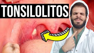 TONSILOLITOS👄💀 ¿Cómo ELIMINAR las bolitas blancas de la garganta [upl. by Ybsorc]