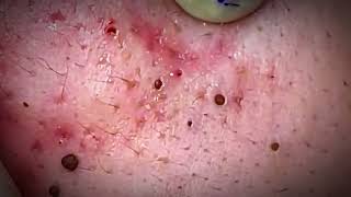 Extreme Blackhead Removal Ever 2024 [upl. by Assili]