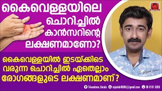 കൈവെള്ളയിലെ ചൊറിച്ചിൽ കാൻസറിന്റെ ലക്ഷണമാണോ  കൈവെള്ളയിൽ ചൊറിച്ചിൽ ഏതെല്ലാം രോഗങ്ങളുടെ ലക്ഷണമാണ് [upl. by Zumstein986]