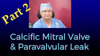 Calcifc Mitral Valve Replacement and Paravalvar Leak Part 2 [upl. by Irot]