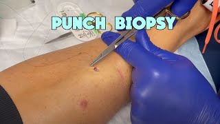 Gigis Punch Biopsy  Dermatofibroma Excision [upl. by Dnomyaw]