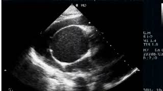 Severe Pulmonic Stenosis  RV non Compaction [upl. by Terraj]