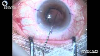 CATARACTE Rupture périphérique sans vitrectomie Implant sulcus  irrido L [upl. by Heindrick]