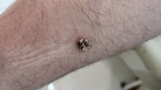 Wart  Weird symptoms and treatment [upl. by Arol228]