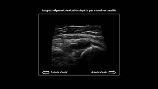 Pes anserinus bursitis on knee ultrasound case 2 [upl. by Dnumyar]