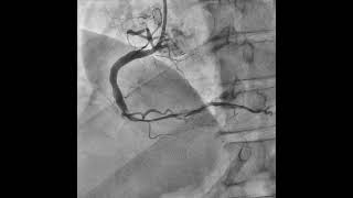 Large Thrombus Burden in a Large RCA [upl. by Wylma]