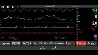 Pulseless Electrical Activity [upl. by Oeram]