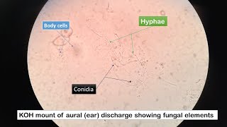 KOH mount of Aural discharge with fungal elements Hyphae and Conidia [upl. by Meid914]