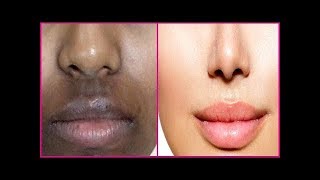 होठों के आसपास का कालापन तुरंत दूर करें  Remove darkness spots  pigmentation around mouth [upl. by Spiro]