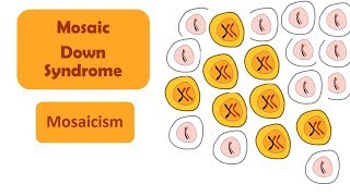 Mosaic Down Syndrome  Mosaicism  A type of Down Syndrome [upl. by Lucine]