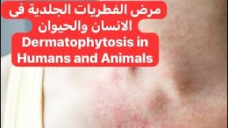 نبذة مختصرة عن مرض فطريات الجلد فى الانسان والحيوان Dermatophytosis in Humans and Animals [upl. by Kerril897]