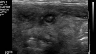 Ultrasound of acute appendicitis [upl. by Lednor]