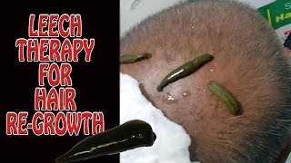 Leech therapy for hair regrowth  Performing By Senior Panchkarma Consultant of Dr Monga Medi Clinic [upl. by Stamata]