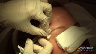 Filler for Forehead Wrinkles procedure [upl. by Dowell]