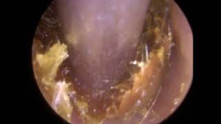 Ear Wax Extraction of Sticky Ear Wax  Ep 288 [upl. by Waugh]