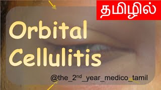 ORBITAL CELLULITIS  தமிழில்  Ophthalmology  MBBS [upl. by Eetnuahs]