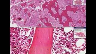 Histopathology BonePaget disease [upl. by Kamp]