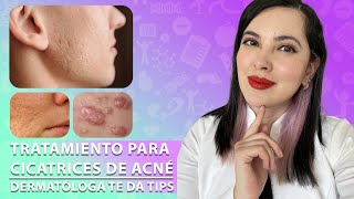 Como se tratan las CICATRICES DE ACNÉ Tips de una Dermatóloga 👩🏻‍⚕️ [upl. by Uok]