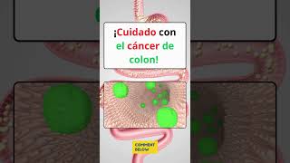 🚨¡CUIDADO SI TIENES UNO DE ESTOS SIGNOS PUEDES TENER CÁNCER DE COLON [upl. by Bolen]