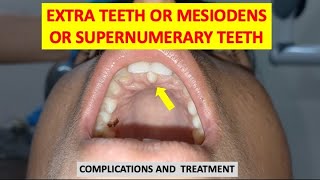 SUPERNUMERARY TEETH MESIODENS EXTRA TEETH COMPLICATIONS AND TREATMENT dentalcafe4331 [upl. by Deroo]