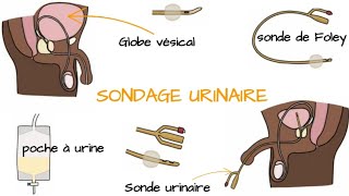 Comprendre le SONDAGE URINAIRE [upl. by Compte]